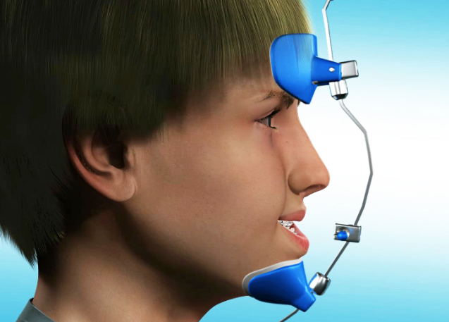 Facemask – giải pháp cho trẻ khớp cắn ngược