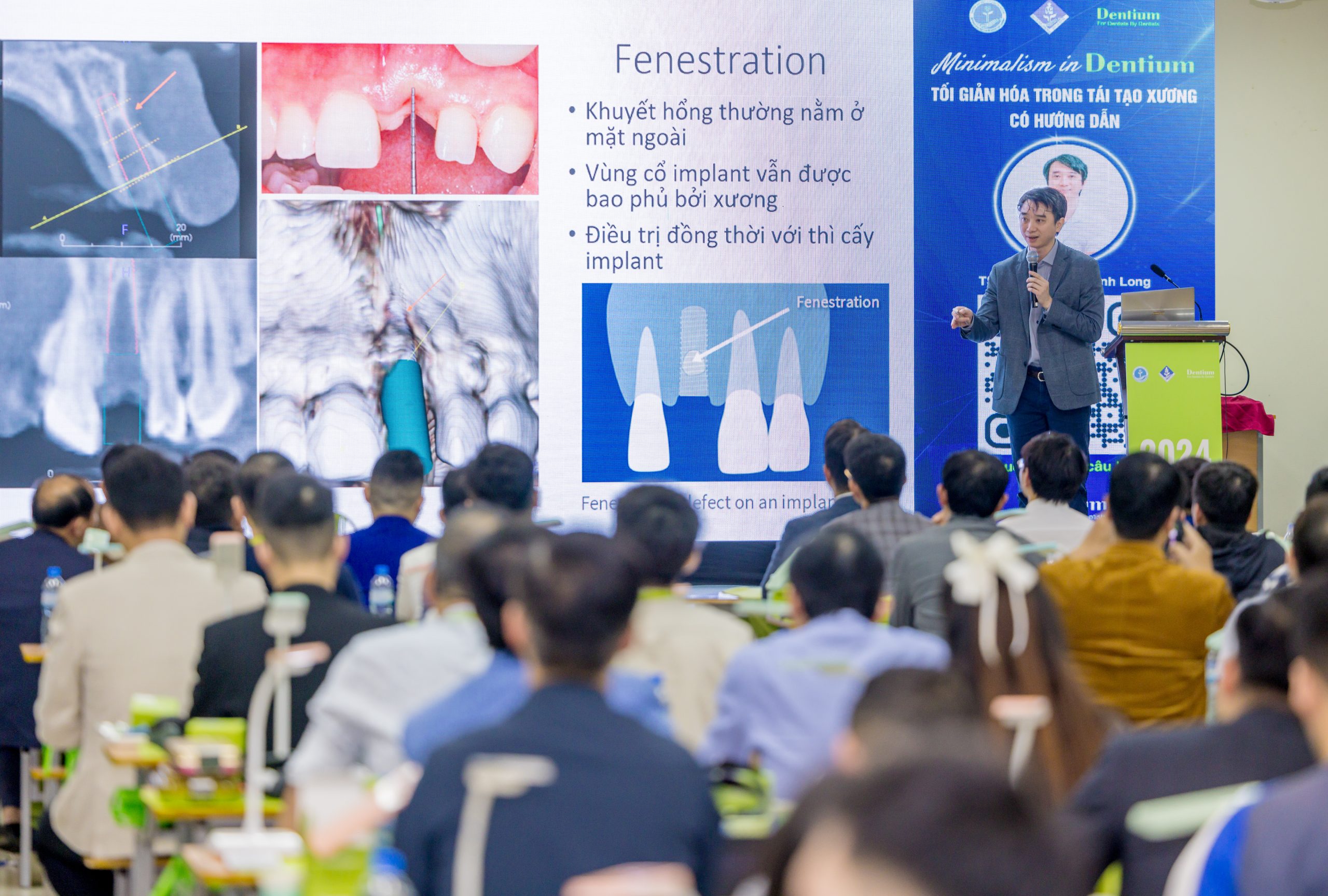 TS.BS Nguyễn Khánh Long báo cáo kĩ thuật ghép xương tại hội nghị Minimalism in Dentium