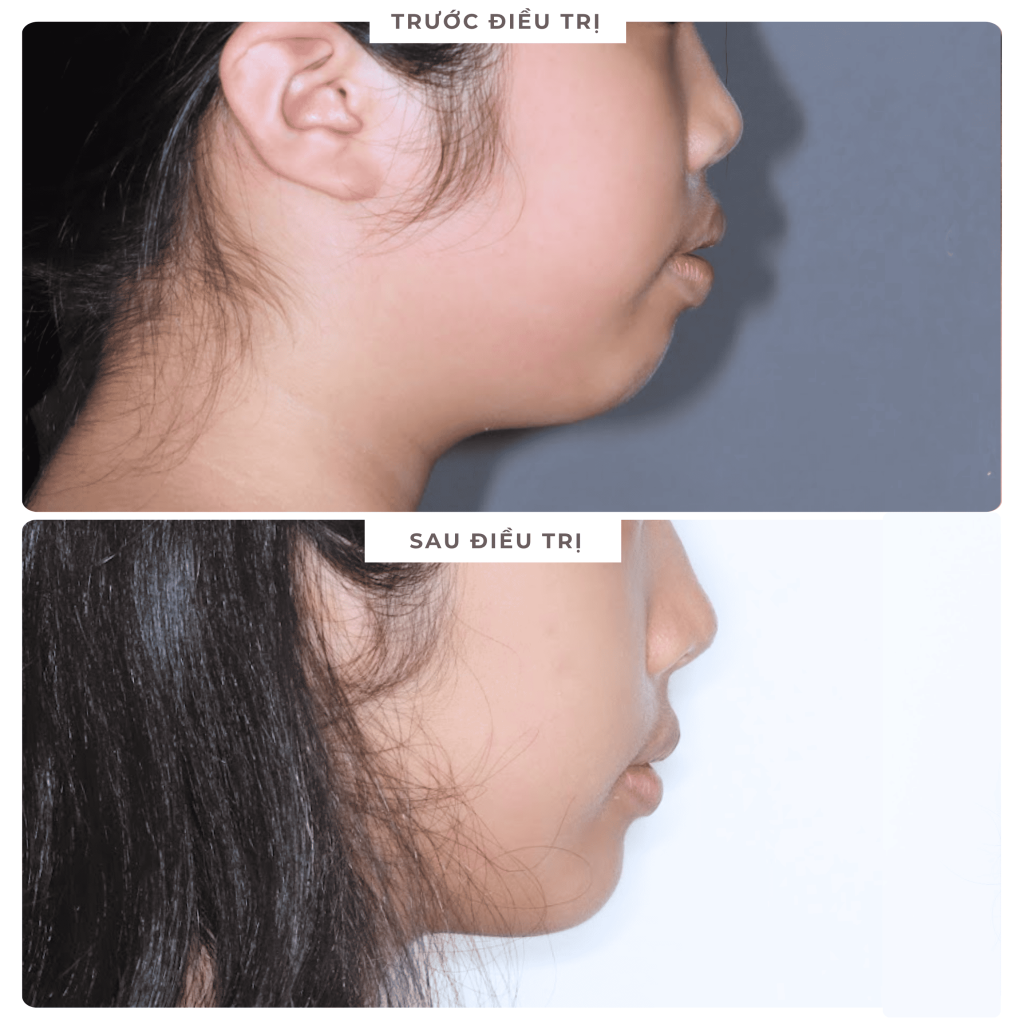 Kết quả niềng răng bảo tồn giúp răng đều đẹp và hết hô chìa