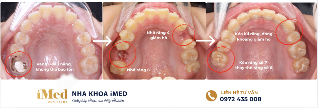 Kỹ thuật kéo răng số 7 thay thế răng mất trong quy trình niềng răng bảo tồn