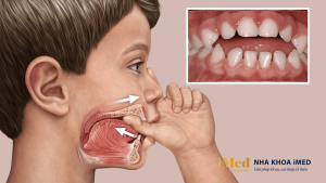 Thói quen mút tay ở trẻ có thể dẫn tới tình trạng sai lệch khớp cắn 