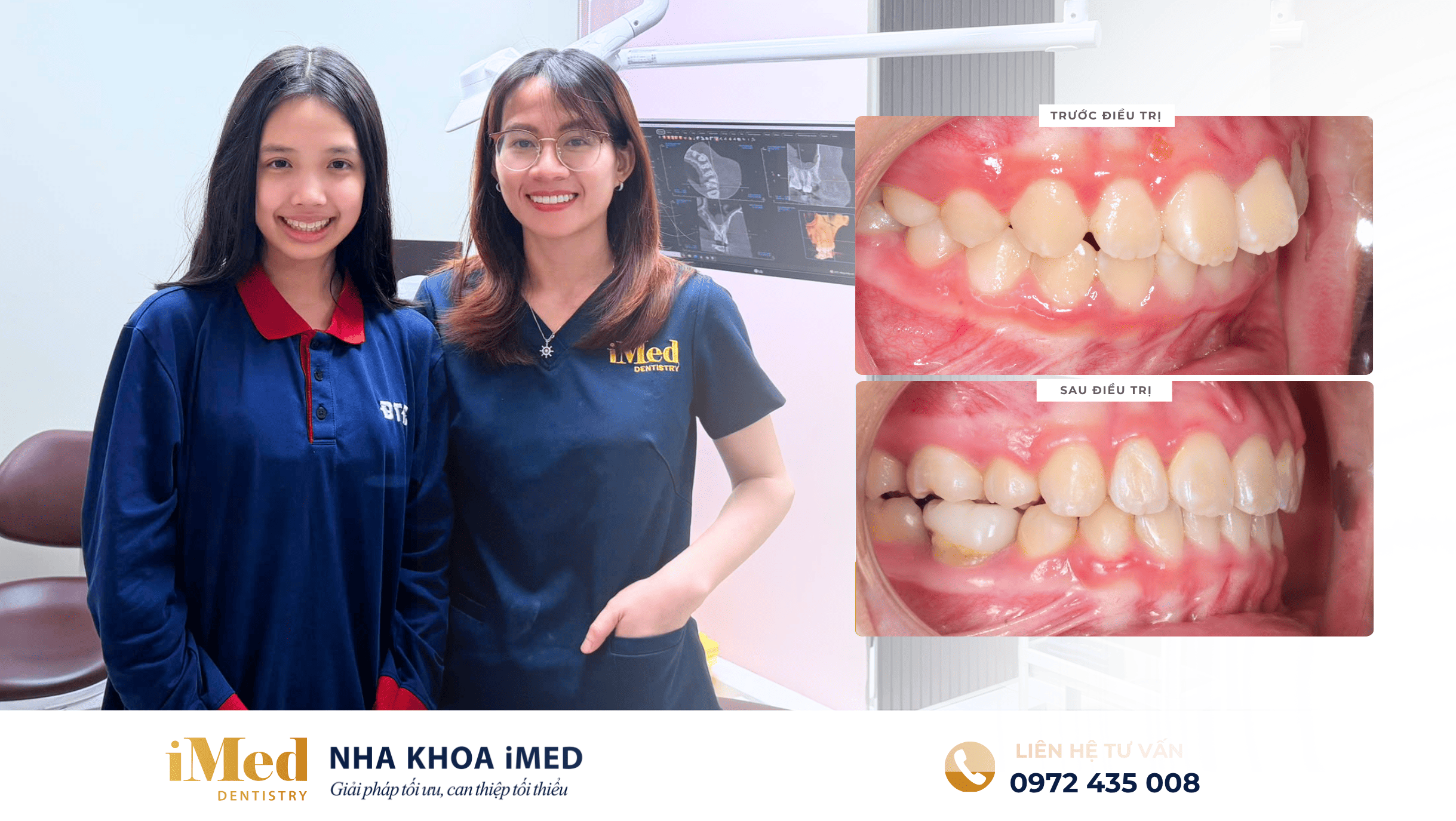 Kết quả niềng răng bảo tồn răng hô chìa và mất răng số 6