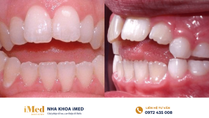 Thói quen đẩy lưỡi diễn ra liên tục ở trẻ gây tình trạng cắn hở vùng răng cửa