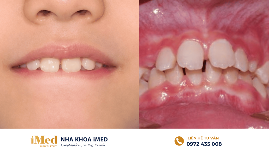 Đặc biệt nguy hiểm trong giai đoạn 6–12 tuổi, thời điểm răng vĩnh viễn đang mọc và xương hàm còn mềm, dễ bị tác động định hình theo thói quen xấu.