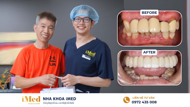 Bệnh nhân phục hình implant toàn hàm tại nha khoa iMed