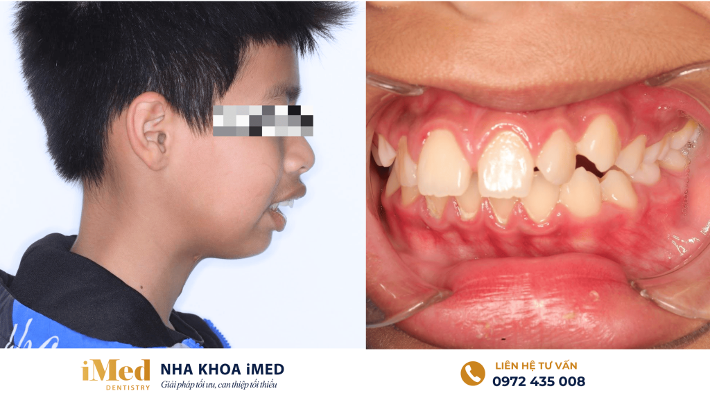 Hình ảnh răng miệng của trẻ bị ảnh hưởng do thói quen xấu