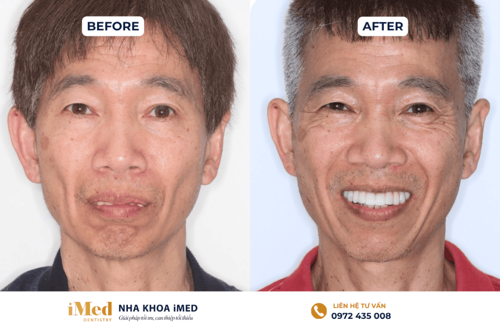 Kết quả điều trị phục hình implant toàn hàm của chú Tùng tại nha khoa iMed